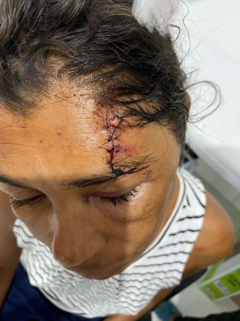 Maria Emília mostra o resultado das últimas agressões do companheiro.